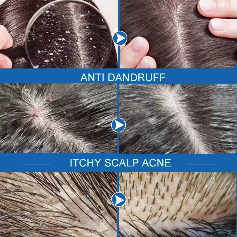 Fast Anti Dandruff Hair Treatm - Hair Care Dandruff recension och pris