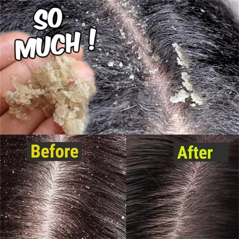 Fast Anti Dandruff Hair Treatm - Hair Care Dandruff recension och pris